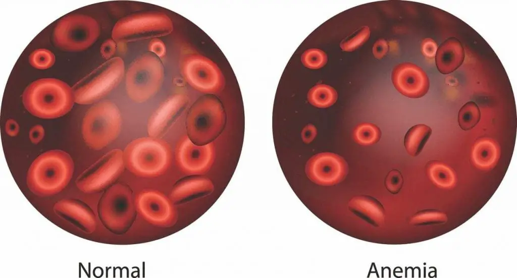 normal red blood cell versus anemia