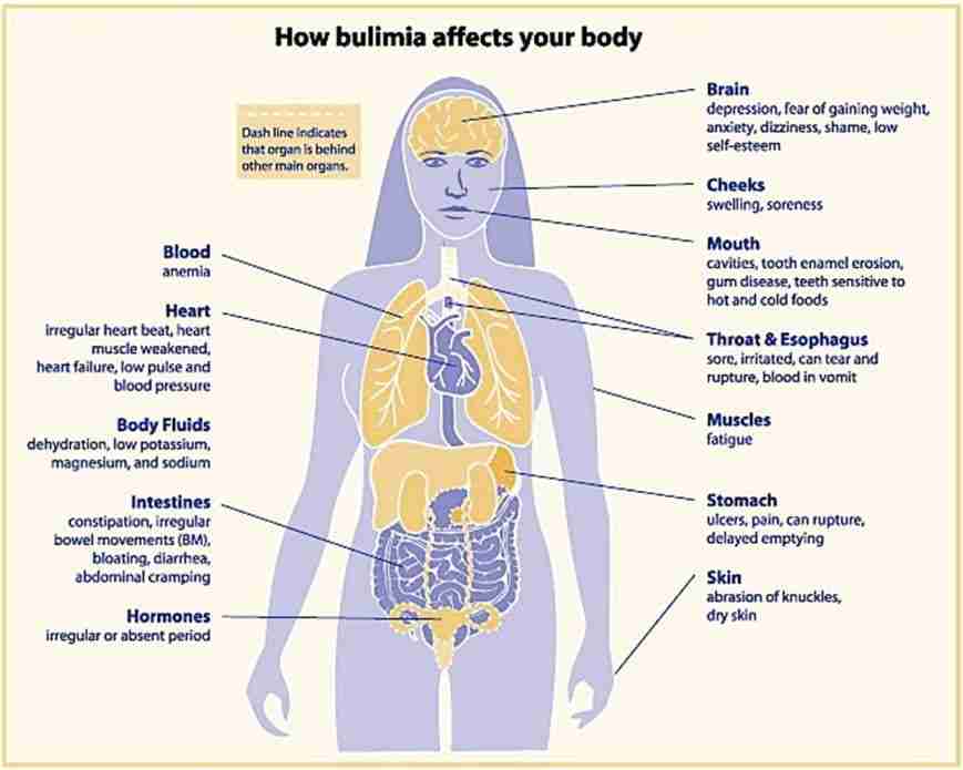 how bulimia affects your body diagram
