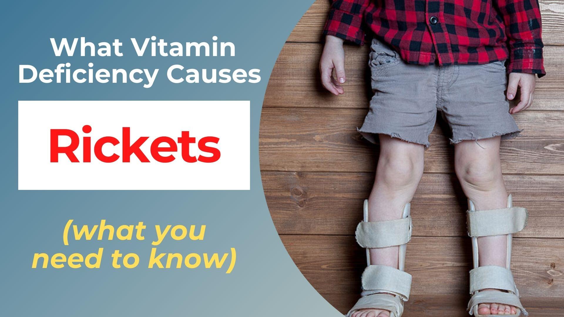 What Vitamin Deficiency Causes Rickets