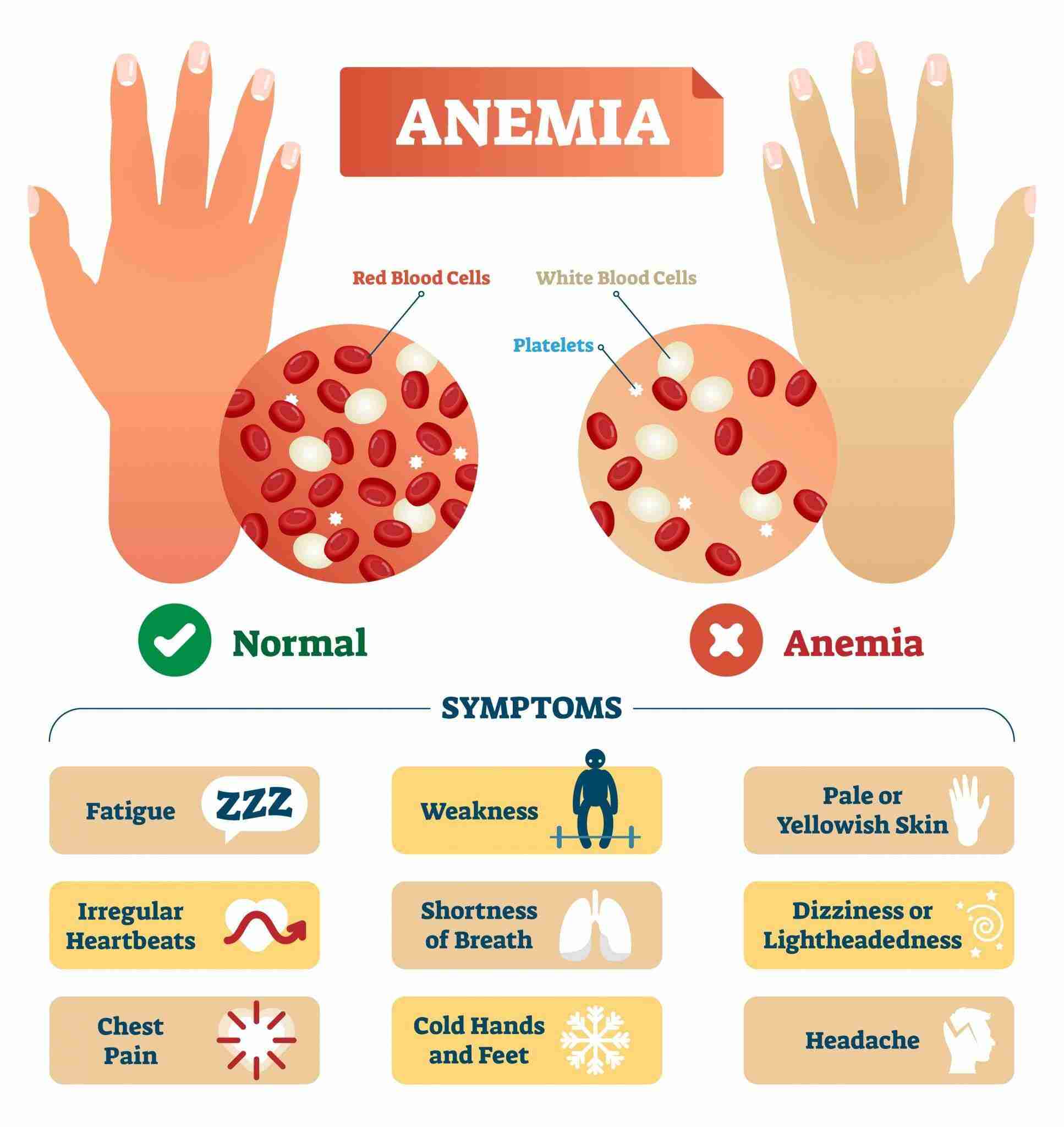 iron-deficiency-anemia