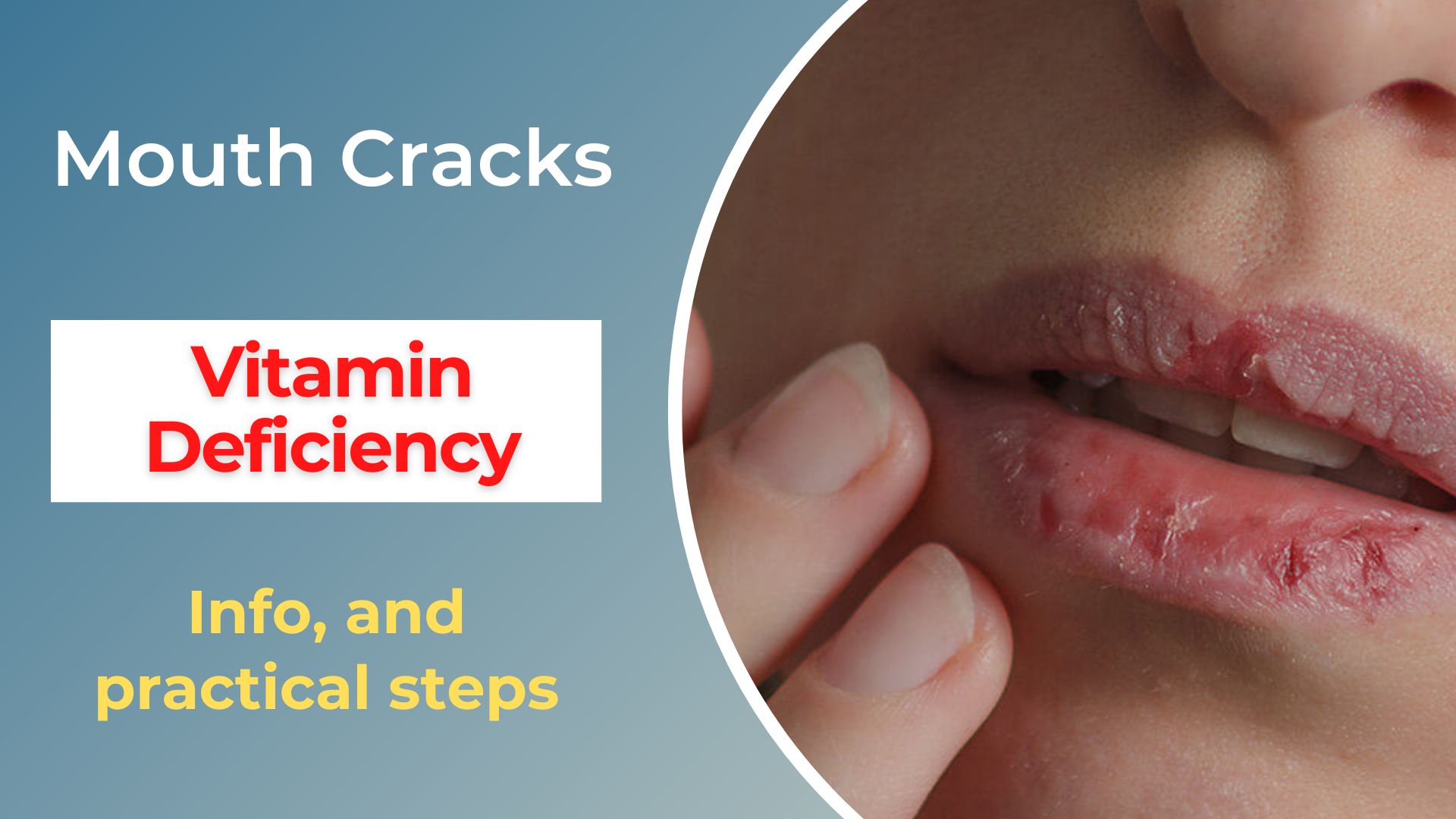 Mouth Corner Cracks Vitamin Deficiency