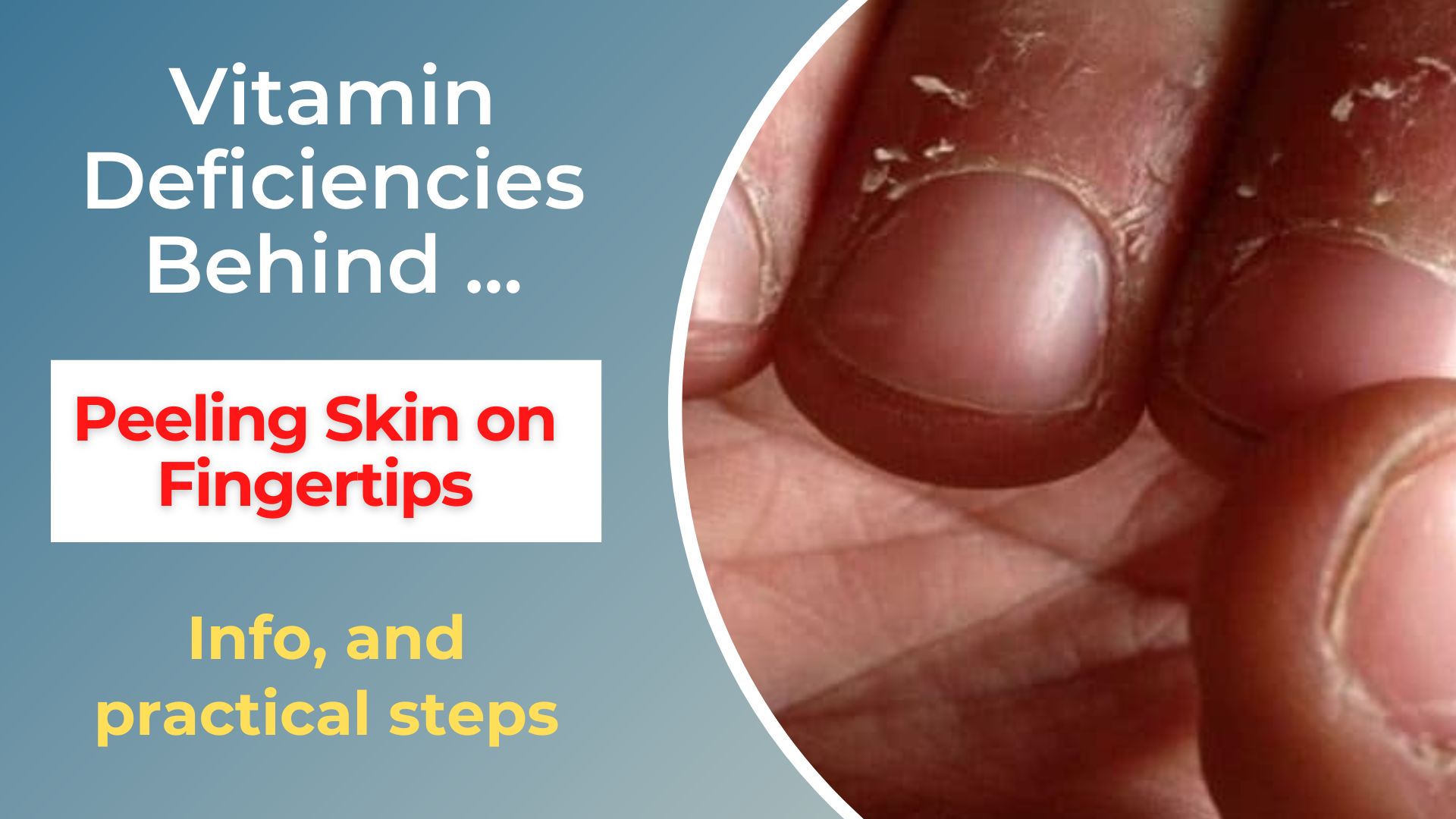 peeling skin on fingertips vitamin deficiency