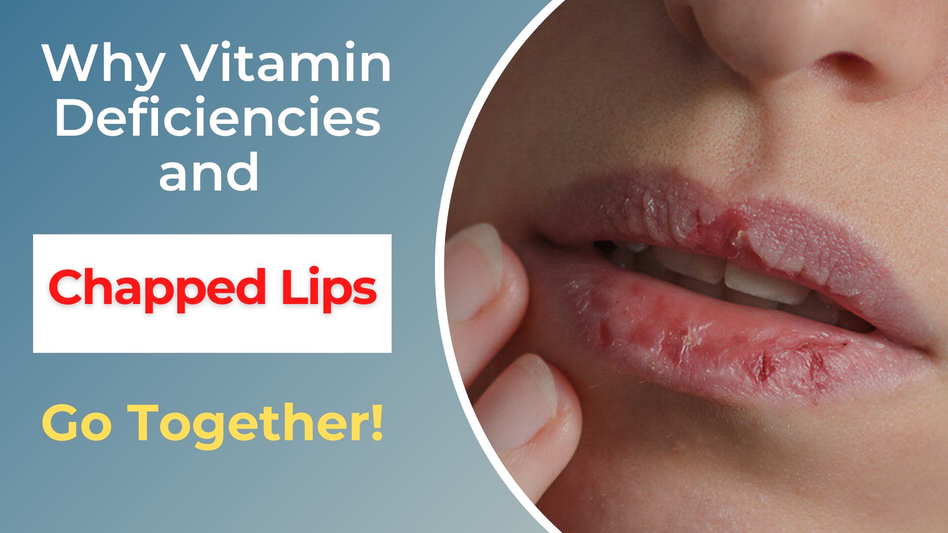 vitamin deficiency chapped lips