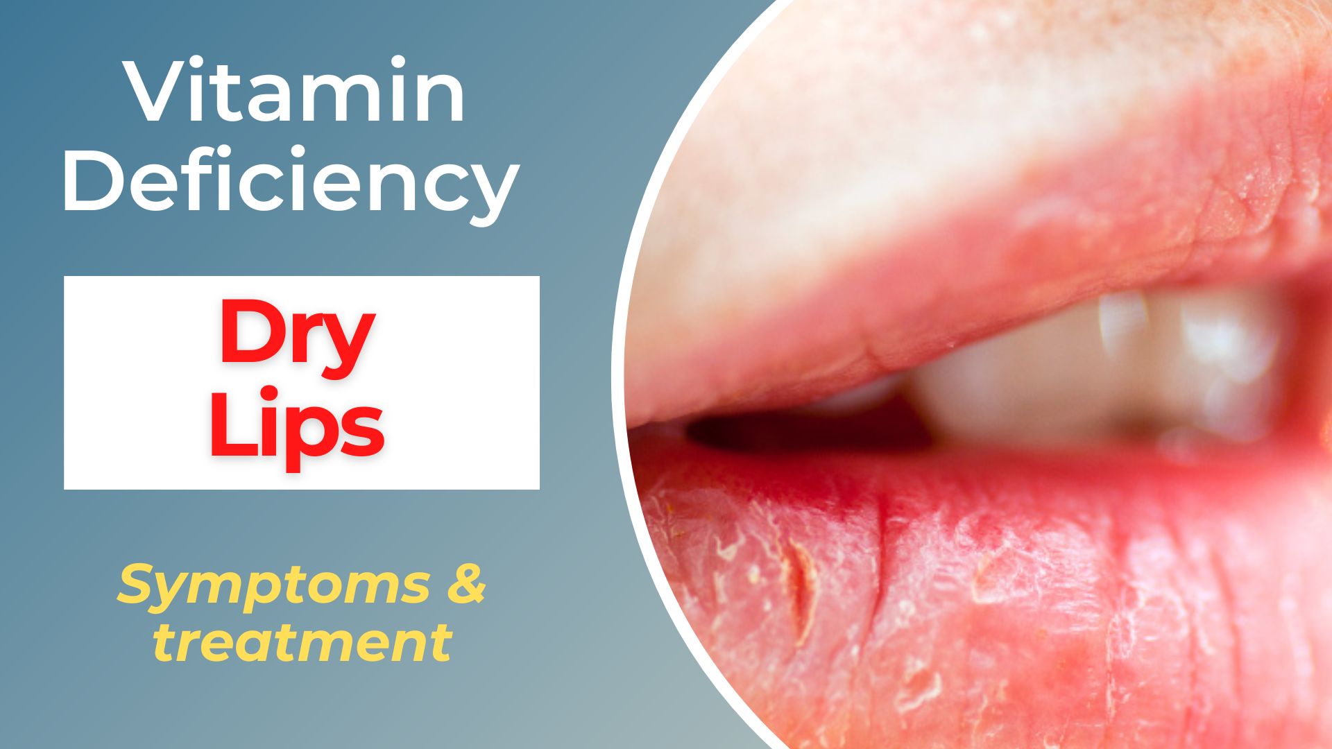 vitamin deficiency for dry lips