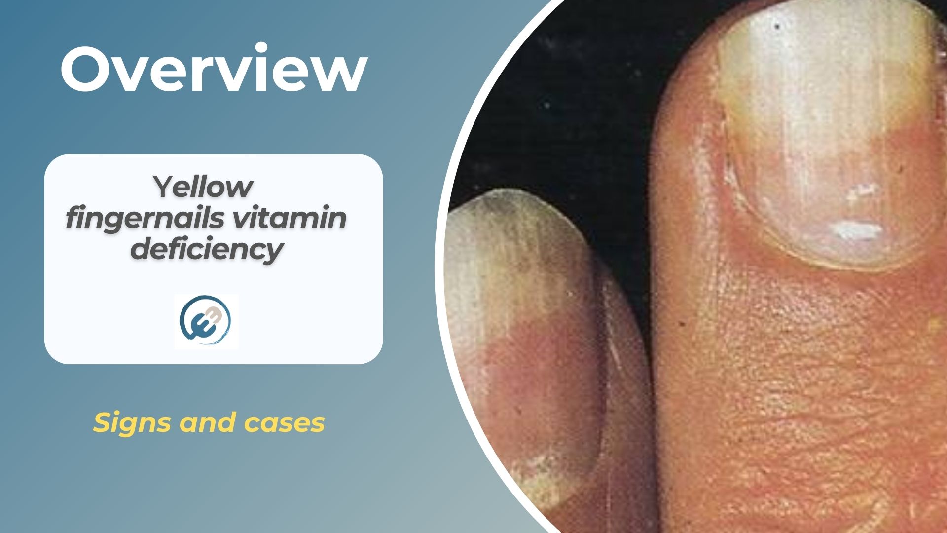 Signs and cases of yellow fingernails vitamin deficiency and remedies