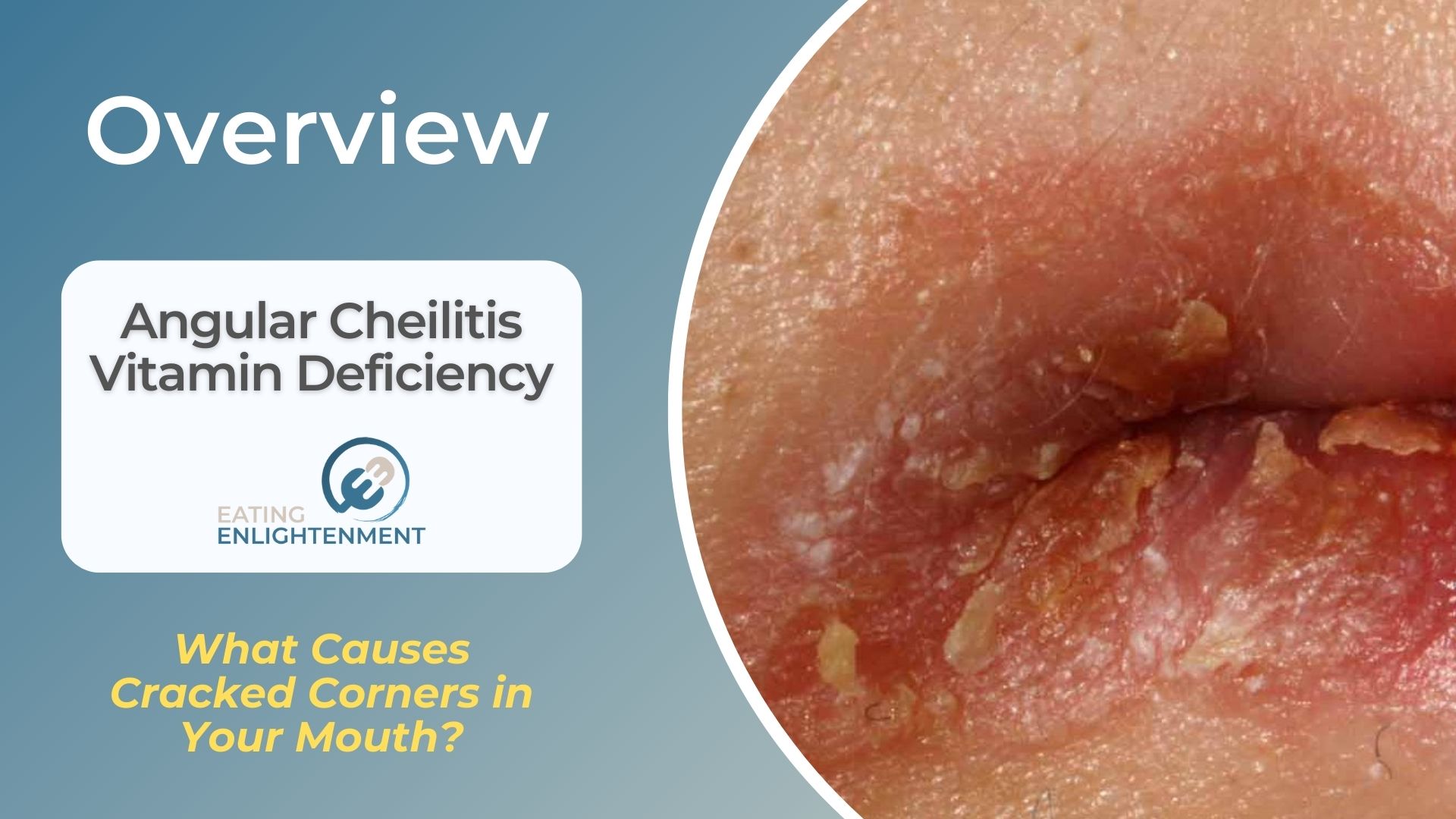 Angular Cheilitis Vitamin Deficiency What Causes Cracked Corners in Your Mouth