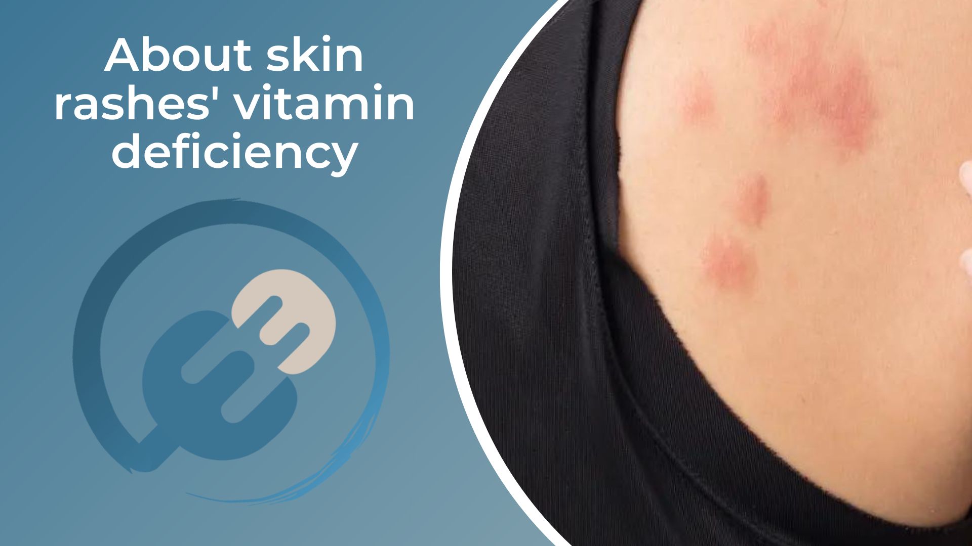 About skin rashes' vitamin deficiency