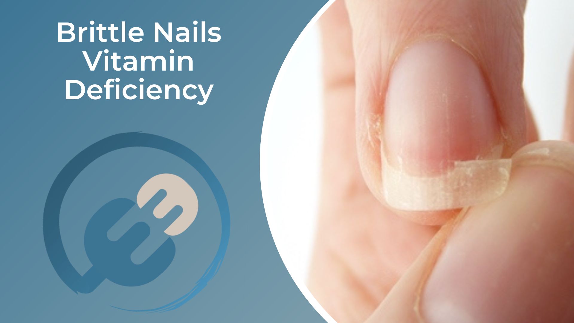 The Real Cause of Brittle Nails: Brittle Nails Vitamin Deficiency — Eating  Enlightenment