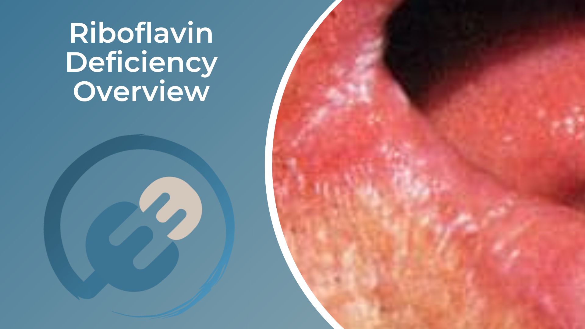 Riboflavin Deficiency Overview