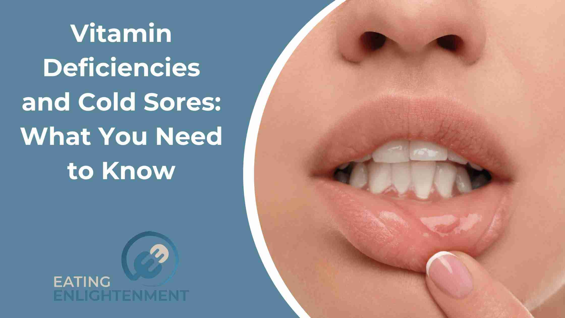 Vitamin Deficiencies and Cold Sores: What You Need to Know
