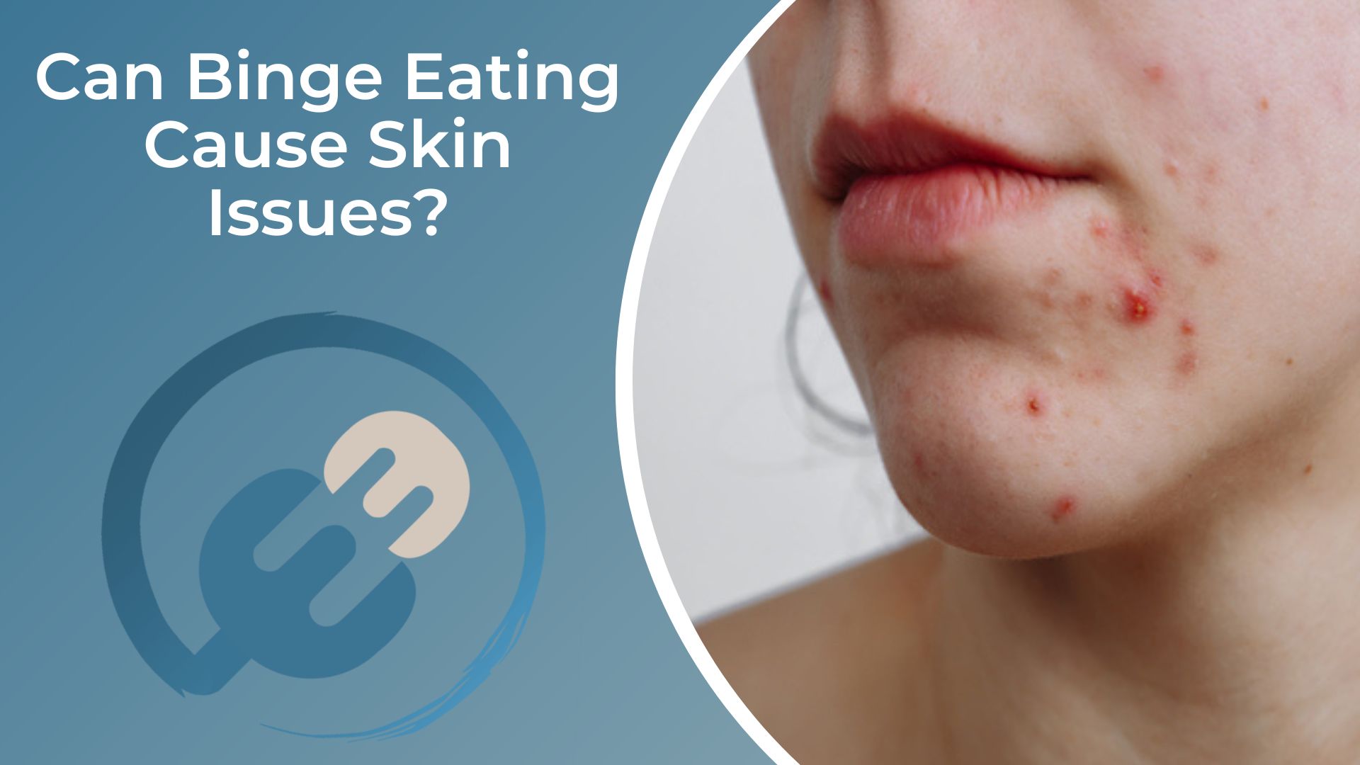 Can Binge Eating Cause Skin Issues