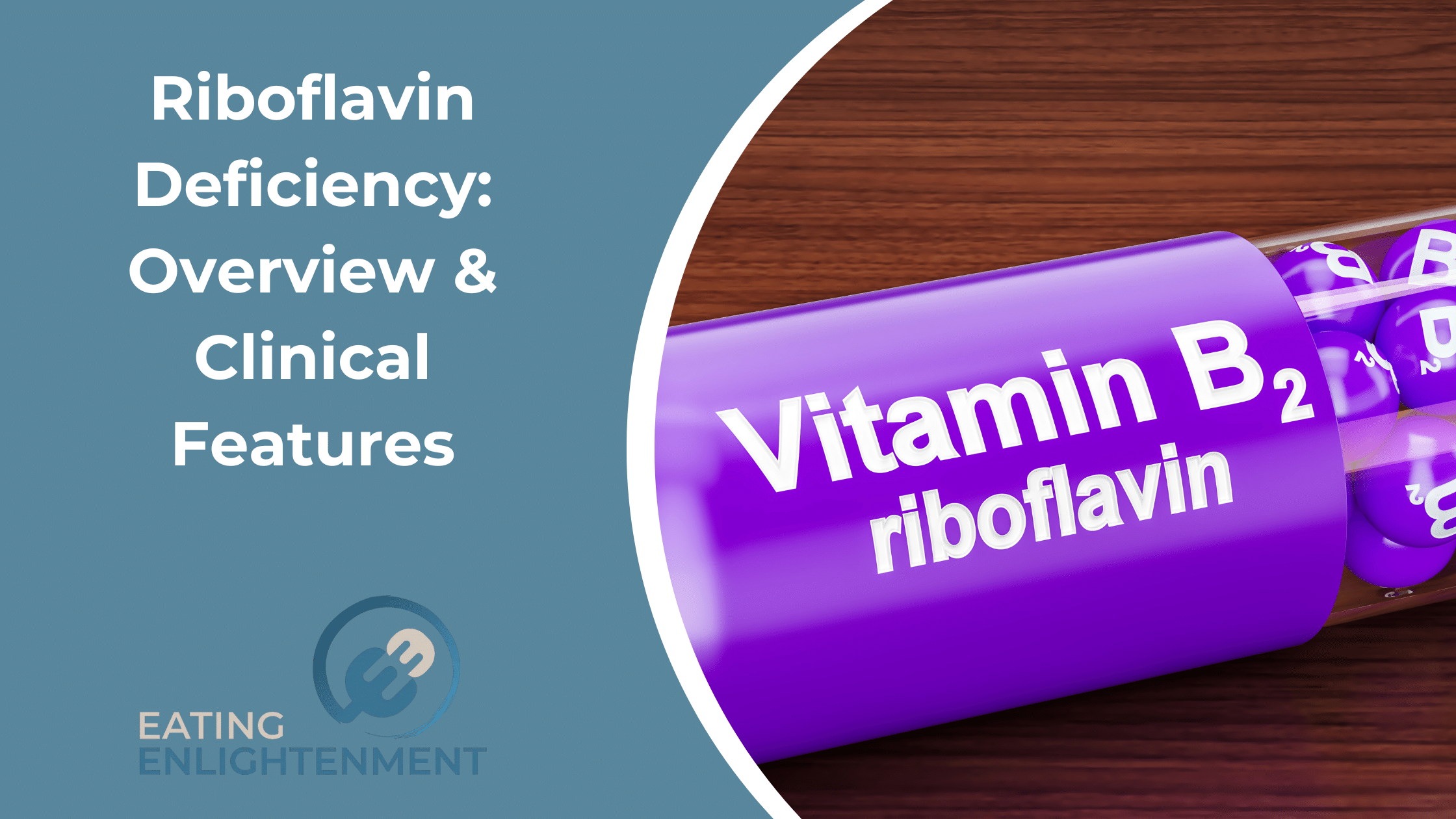 Riboflavin Deficiency: Overview & Clinical Features