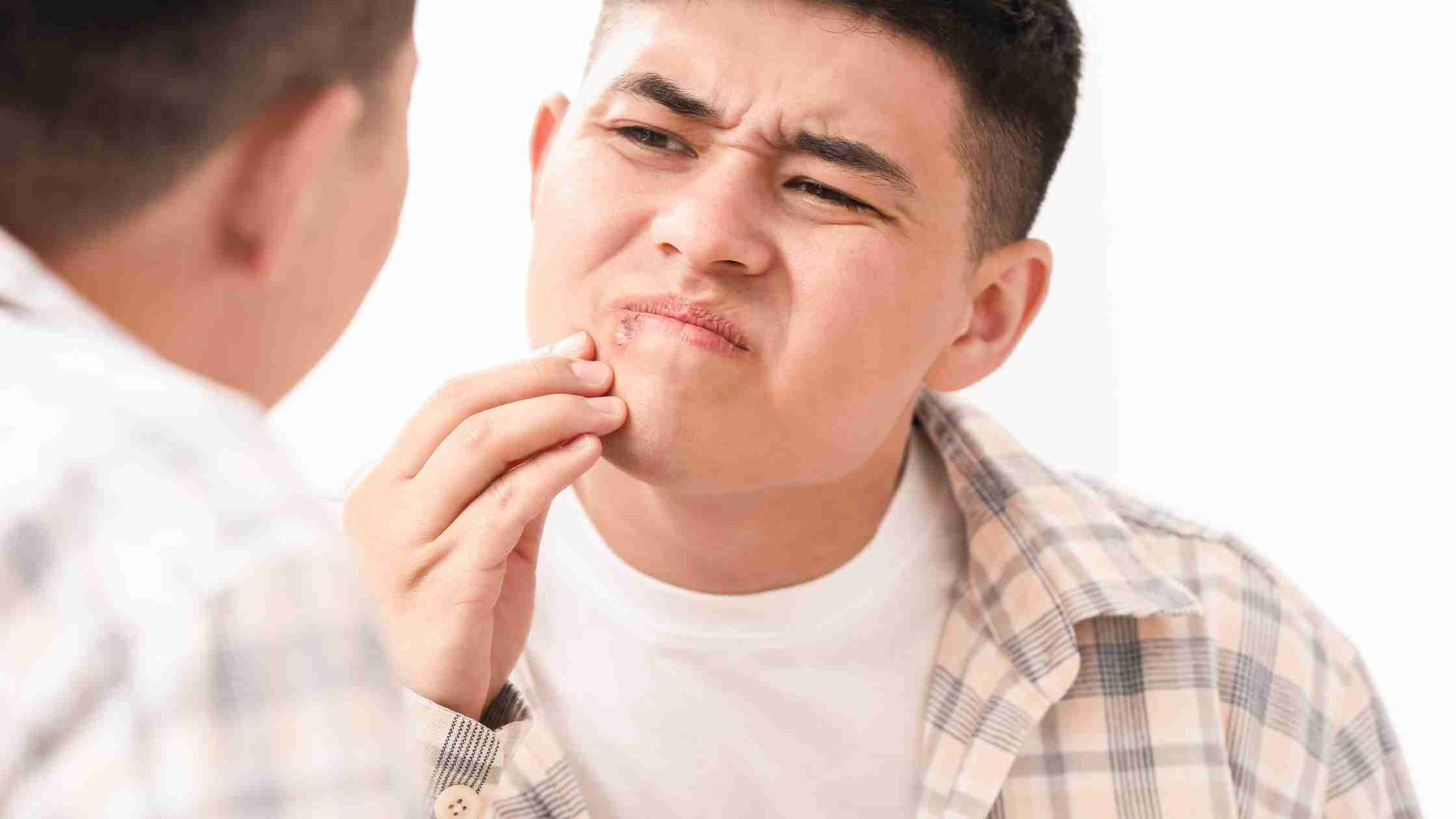 Cold Sores and Herpes: Understanding the Connection