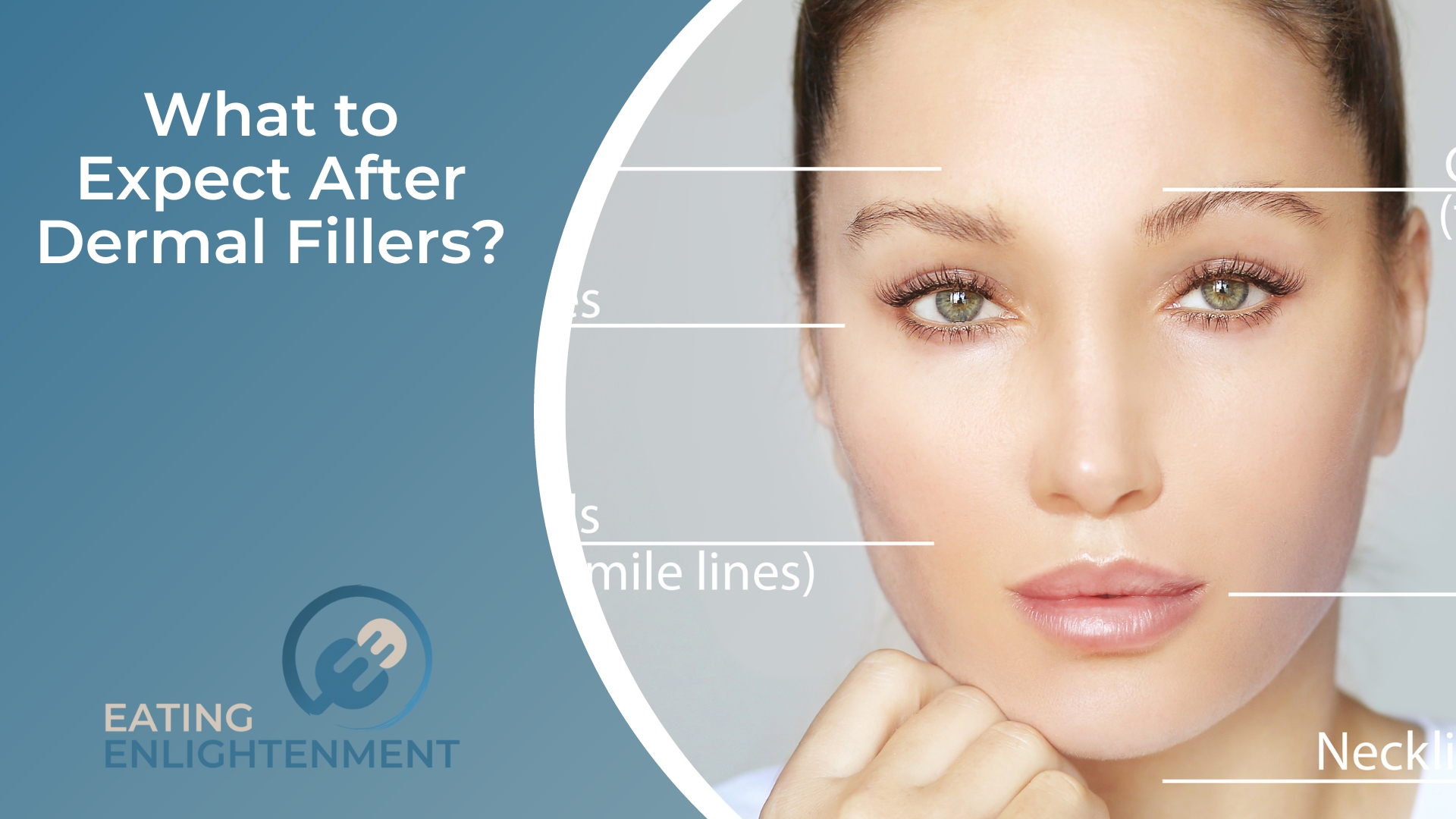What to Expect After Dermal Fillers
