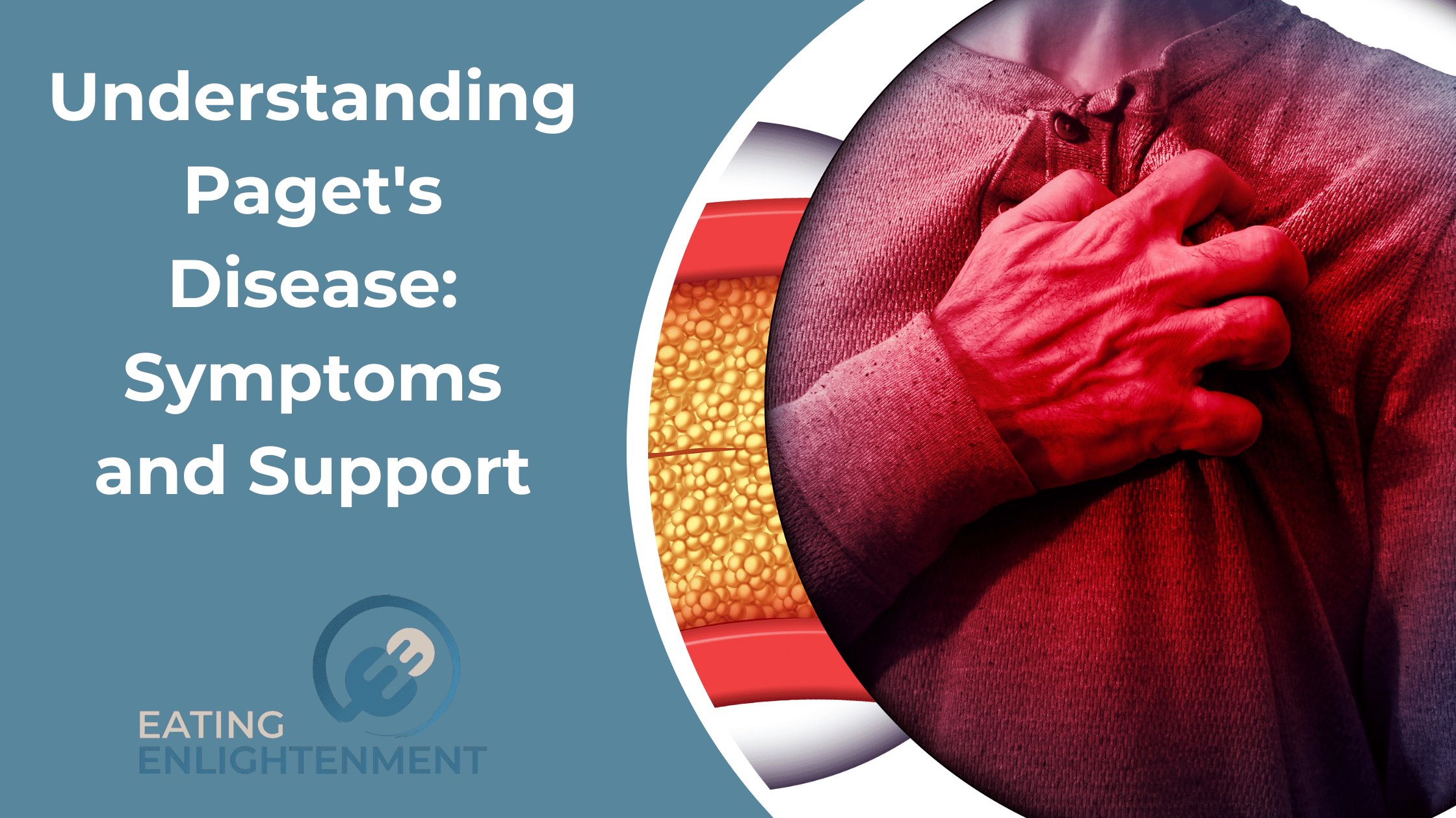Understanding Paget's Disease: Symptoms and Support