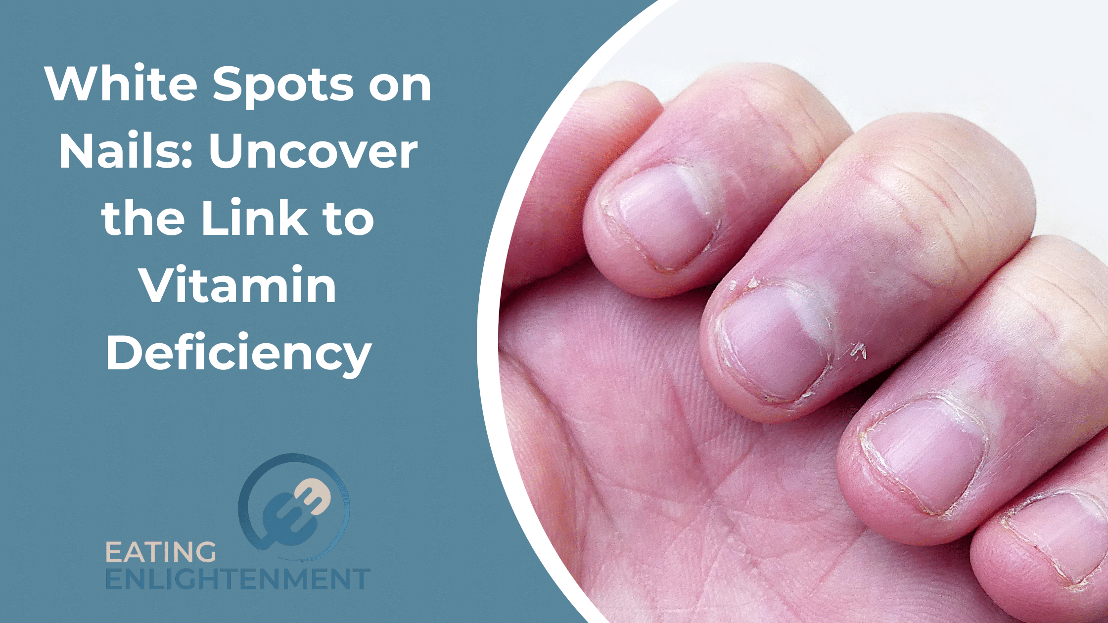 White Spots on Nails: Uncover the Link to Vitamin Deficiency